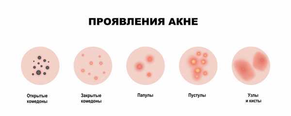 Юношеские угри