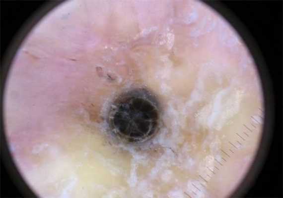 Открытый комедон под увеличением