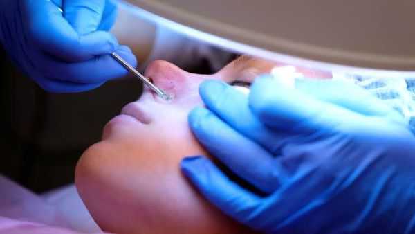 Механическое удаление чёрных точек