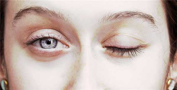 Кризы при миастении