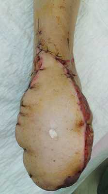 Пересадка лоскута на сосудистой ножке не только закрывает раны, но и улучшает кровообращение