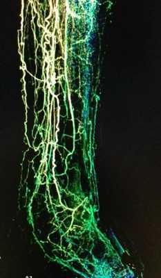 Ангиография при болезни Бюргера - видны множественные коллатерали, основные стволы закрыты