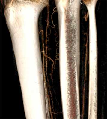 Характерные спирали коллатералей при тромбангиите