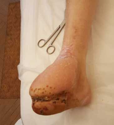 Лоскут, пересаженый на рану стопы при тромбангиите восстановил кровоснабжение