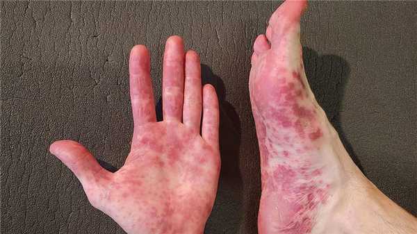 Поражение кожи вирусом Коксаки у взрослого человека