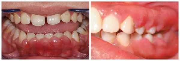 Гипертрофия мягких тканей