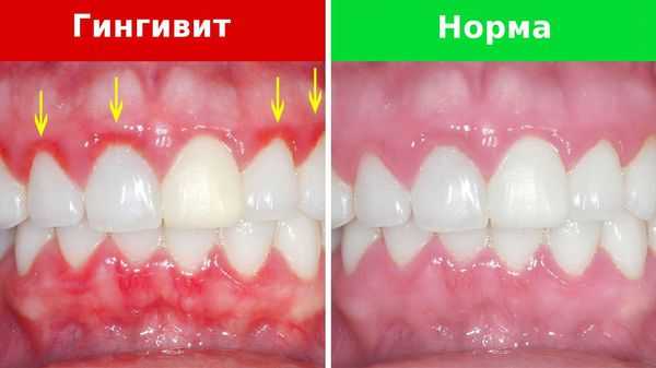 Покраснение дёсен и здоровые дёсны