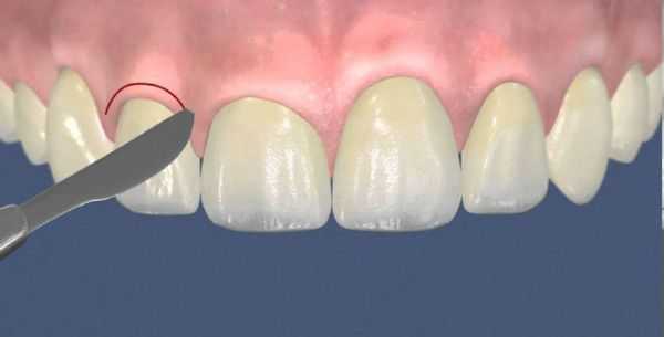 Гингивэктомия