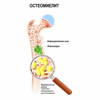 Остеомиелит.jpg