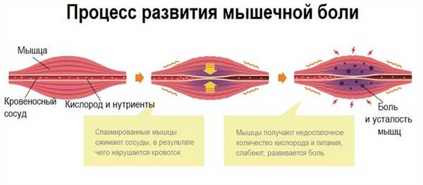 Мышечная боль.jpg