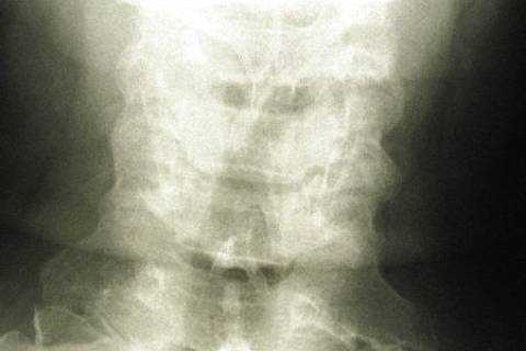 Краниоцервикальные аномалии