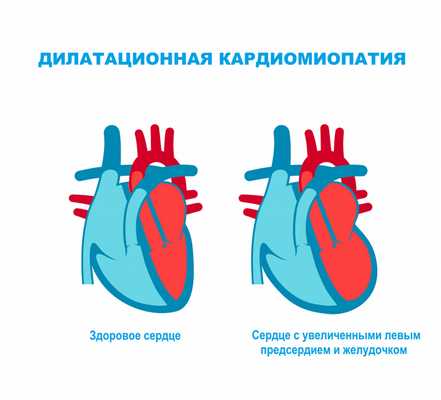Дилатационная кардиомиопатия.jpg