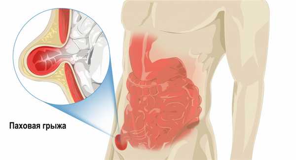 Паховая грыжа.jpg