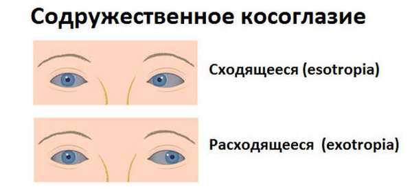 Сходящееся, расходящееся содружественное косоглазие