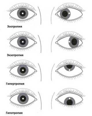 Сходящееся косоглазие у взрослых и детей