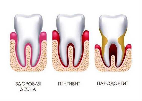 Гингивит и пародонтит