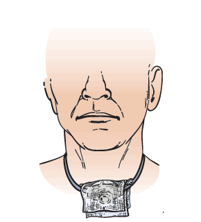 Рисунок 4. Увлажненная марля поверх отверстия трахеостомической трубки