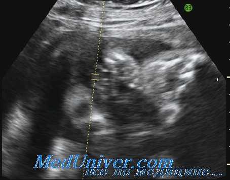 задержка внутриутробного развития