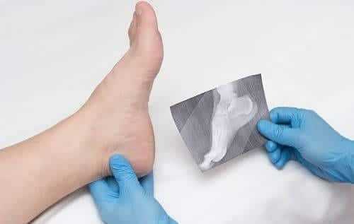 Рентгеновский синмок стопы с большеберцовым невритом