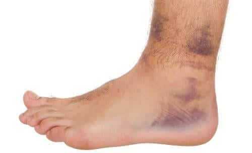 Отек и синяки стопы вызывают неврит большеберцового нерва