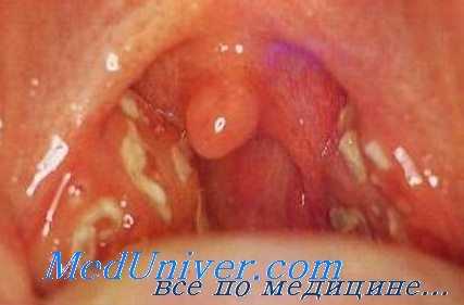 флегмонозная ангина