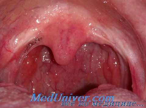 заглоточный гнойник