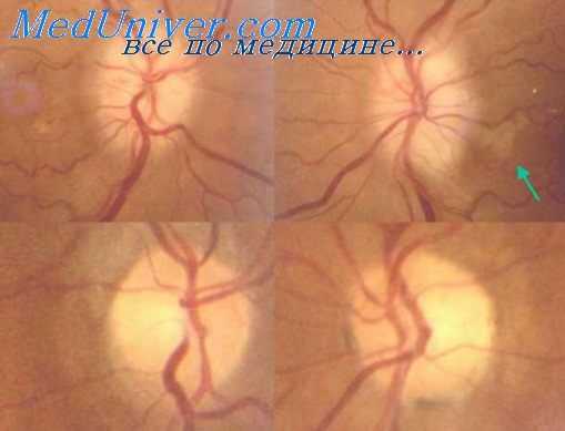 сопряженные фокусы