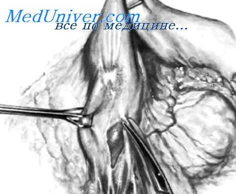 закрытие культи двенадцатиперстной кишки