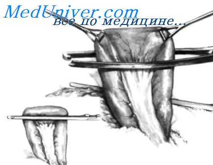 резекция желудка по Billroth II