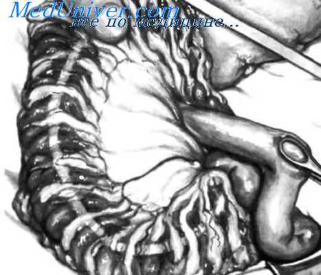 резекция желудка по Billroth II