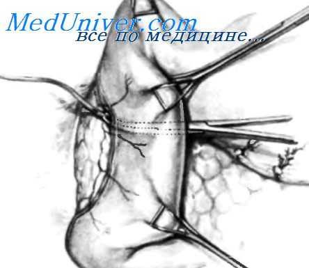 закрытие двенадцатиперстной кишки