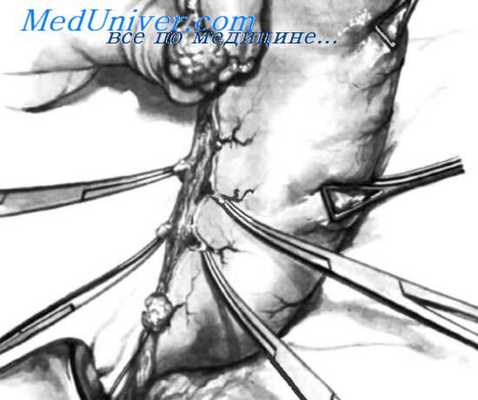 резекция желудка по Billroth II