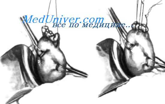 резекция желудка по Billroth II