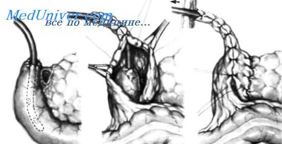 закрытие двенадцатиперстной кишки