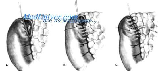 закрытие двенадцатиперстной кишки
