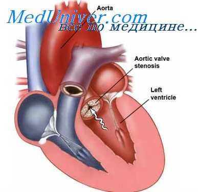 межжелудочковое отверстие
