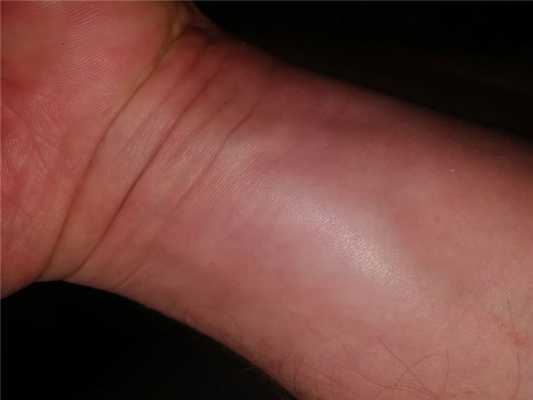 отечность кисти