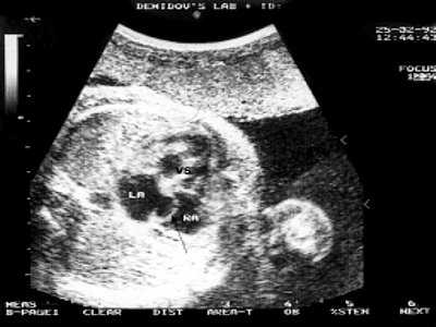 УЗИ: четырехкамерное сечение сердца плода в 30 недель гестации, опухоль сердца