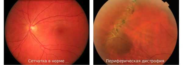 Сетчатка здорового глаза и сетчатка при периферической дистрофии