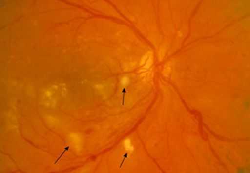 Ватообразные очаги