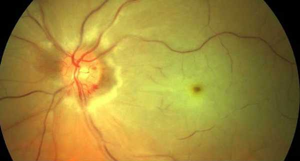 Окклюзия центральной вены сетчатки