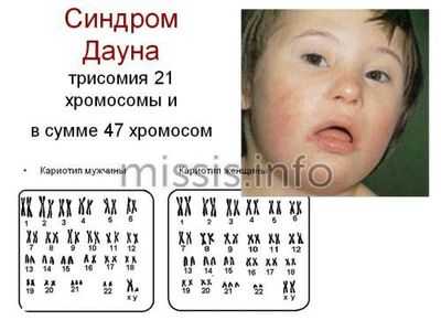 Лишняя хромосома у ребенка