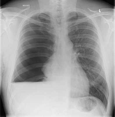 Скопление жидкости в плевральной полости. Рентгенография.