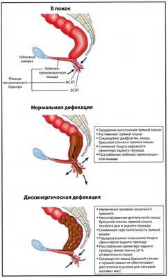 Рис. 2. Строение (в сагиттальной плоскости) и физиология тазового дна в покое, при нормальной и диссинергической дефекации. На верхнем рисунке показано строение внутреннего (ВСЗП) и наружного сфинктеров заднего прохода (НСЗП) в покое и лобково-прямокишечной мышцы. При дефекации сфинктеры заднего прохода и лобково прямокишечная мышца расслабляются, а мышцы брюшной стенки и прямой кишки сокращаются, что способствует выталкиванию кала из прямой кишки. При дискинетическом запоре сокращение мышц, необходимое для продвижения кала к заднепроходному каналу, и расслабление сфинктеров заднего прохода и лобково-прямокишечной мышцы могут нарушаться, что ведет к несогласованной работе мышц при попытке дефекации (диссинергии) и задержке кала [10]
