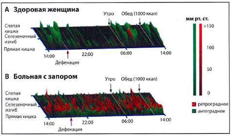 Рис. 1. Результаты 24-часовой высокочувствительной манометрии толстой кишки (А) у здоровой женщины из контрольной группы и (В) женщины, с расстройством дефекации. Графики представляют собой пространственно-временные карты антеградно (зеленый) и ретроградно (красный) распространяющегося сокращения толстой кишки. У здоровой женщины (А) высокоамплитудные распространяющиеся сокращения ясно различимы утром после пробуждения и перед дефекацией. У больной с расстройством дефекации (В) наблюдаются множественные низкоамплитудные сокращения высокой частоты, которые идут как в антеградном, так и ретроградном направлении, и снижение частоты высокоамплитудных распространяющихся сокращений. Кроме того, у этой больной моторная активность ночью не снижается, а в ответ на употребление высококалорийной пищи, напротив, не повышается [49]