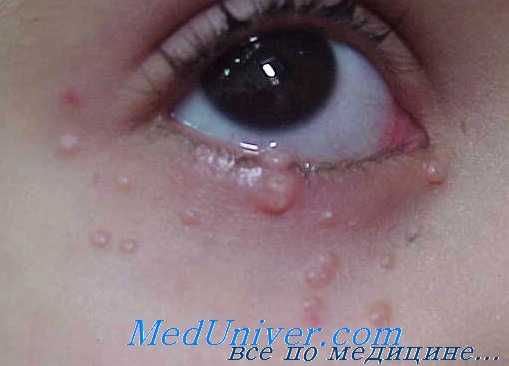 контагиозный моллюск века