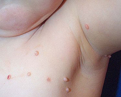 контагиозный моллюск у детей