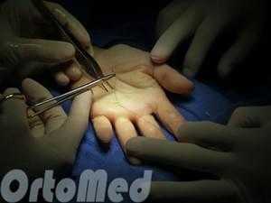 щелкающий палец операция