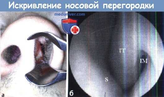 Искривление носовой перегородки