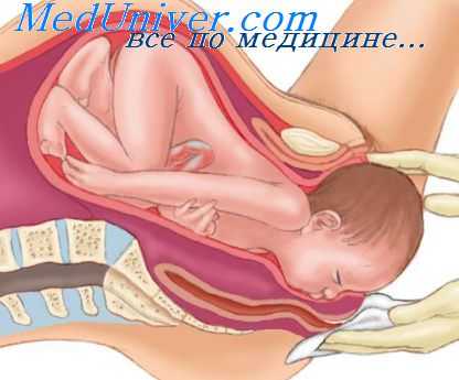 затяжные роды